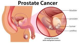 Prostate Cancer: Symptoms, Causes & Treatment | Cancer Specialist Hospital in Thane