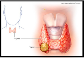 Thyroid Cancer Specialist Doctor in thane : Types, Symptoms, Causes & Treatment