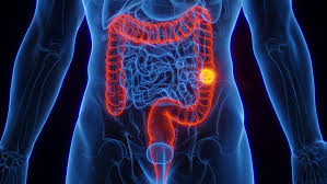 Colorectal Cancer | Colon, Rectal Cancer Symptoms, Stages & Treatment specialist Dr In Thane Mumbai