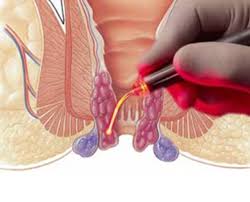 Piles Surgery & Treatment | Piles Hospital in Thane | Expert Piles Doctor