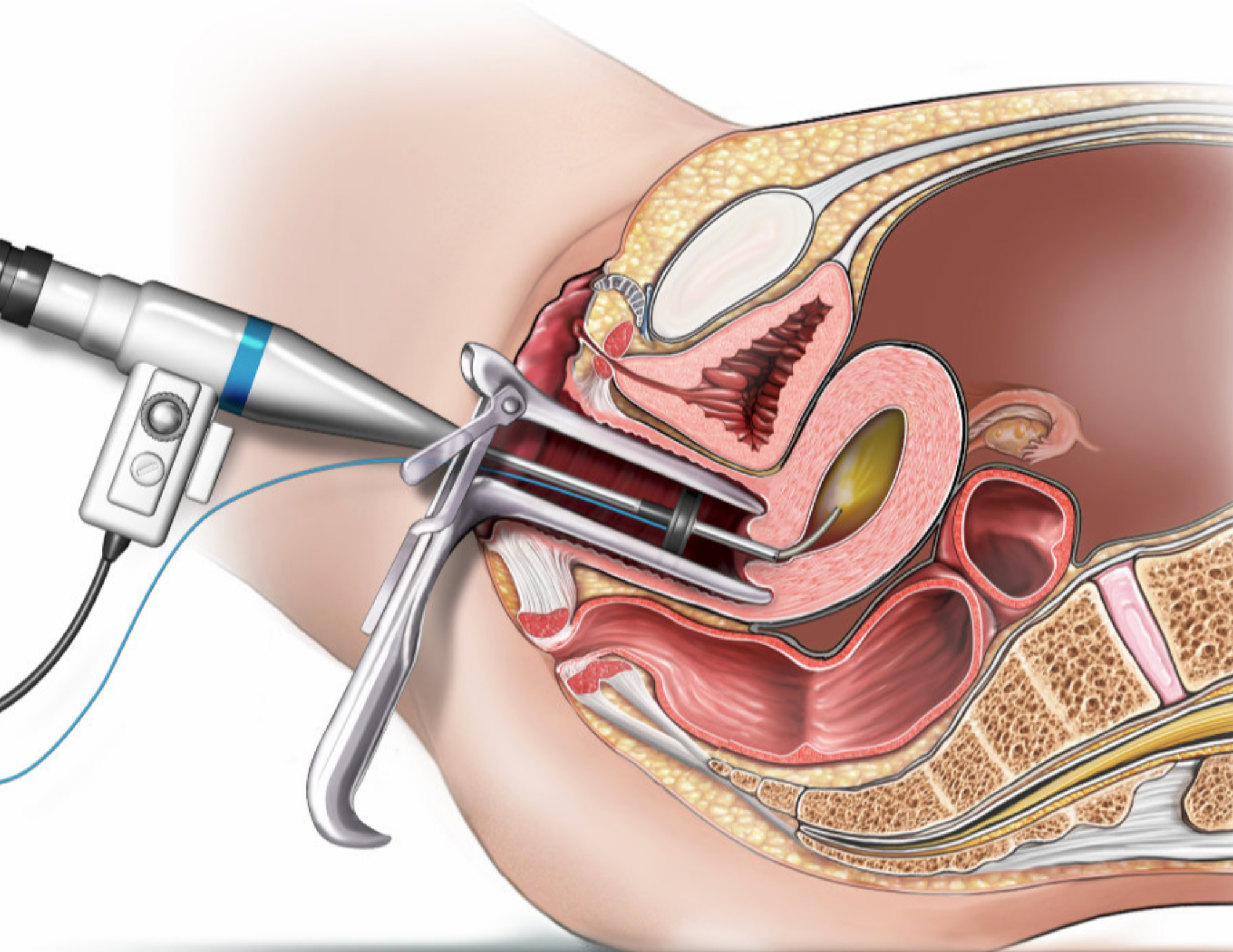 Hysteroscopy Treatment in Thane | Specialist Gynecology Hospital