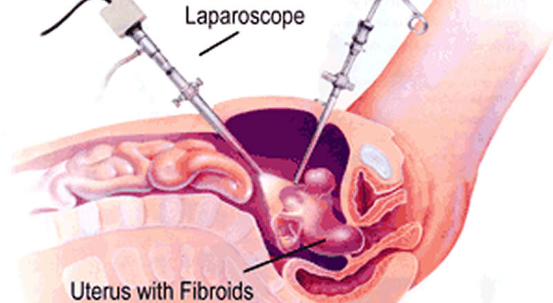 Best Uterine Fibroid Treatment in Thane & Mumbai | Laparoscopic Myomectomy