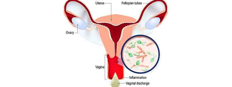 Best Vaginal Infection Treatment doctors in Thane 
