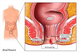 Anal Fissure Treatment in Thane | Laser Surgery & Specialist Care