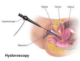 Hysteroscopy Surgery in Thane | Dr Specialist Surgery Hospital for Women’s Health