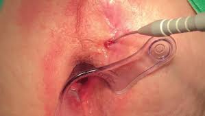 Laser Fistula Surgery in Thane | Fistula Treatment Near Me