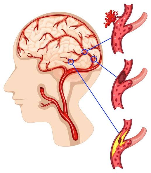 Brain Stroke Treatment in Thane: Symptoms, Causes & Recovery