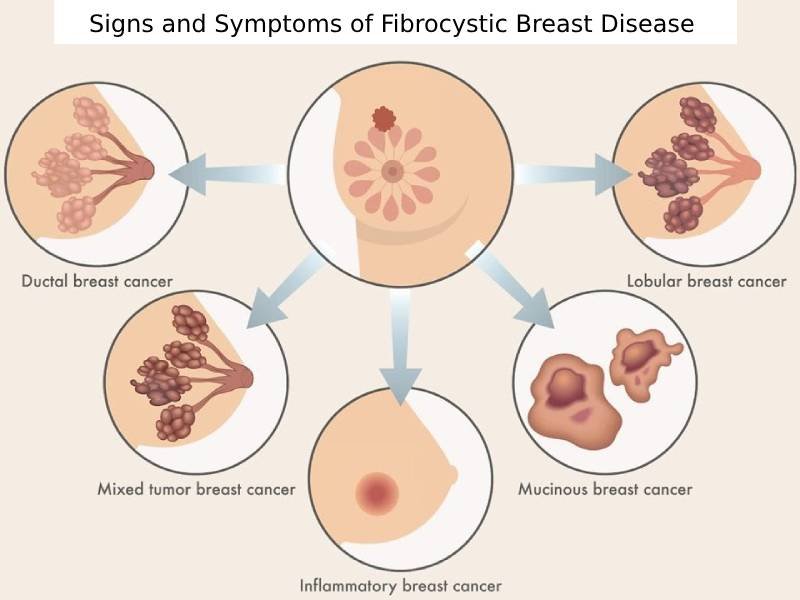 Fibrocystic Breast Lump & Pain: Diagnosis and Treatment Guide